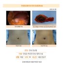 담낭절제술후기. 수술 4일 전부터 복통 및 명치 통증으로 내원, 초음파 검사 후 담석증 진단받고 입원, 다음날 수술하게 되었습니다... 이미지