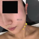 수원 광교 피부관리 경락 아바에스테틱 재방문 후기와 전후 비교