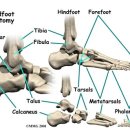 요족인 발에 많이 나타나는 족저근막염 이미지
