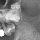365안락한치과의원 | [365안락한치과,동래치과,부산임플란트] 완전 매복 사랑니의 발치