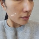 어제와 오늘의 얼굴 | 송도 피부과 텐써마 300샷 고현정리프팅 팔자주름리프팅 후기