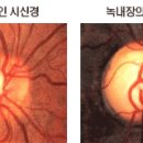 녹내장에 대해서... 이미지