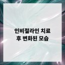 인비절라인 치료 후 변화된 모습