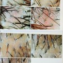 메디플러스 의원 | 원주두피케어, 가려움 비듬 각질때문에 찾아간 스칼프메디 관리후기