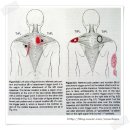 목결림-경추신경근병과 승모근의 통증유발점(trigger point) 이미지