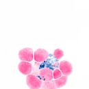 암환자 70% 죽이는 뼈 전이 비밀 풀렸다…“암세포가 철분 빼앗아 골수서 성장” 이미지