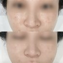 구로-구로-구로-1080 | 구로피부관리 여드름, 흉터 전문 하이필스킨 피부 장벽복구 프로그램 후기