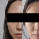 (주)큐브메디 | 메디큐브 울트라튠 40.68 신세계면세점 구매 후기 (두달사용 전후비교 있음)