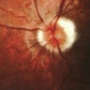 13. 전체 포도막염과 동반된 다초점(다소성)맥락막염(Multifocal choroiditis(MFC)with Pan-uveitis, MCP)