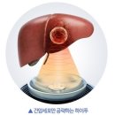 간암의 다양한 치료법과 하이푸 치료법에 관하여 LIVER CANCER HIFU TREATMENT 이미지