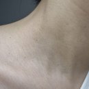 퍼스트케어약국 | 인천 청라 실면도 쥐젖 제거 후기 | 가격·통증·관리법 총정리 (금비 맘스케어 내돈내산)