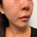 연신내 피부과 꿀광피부 스킨부스터 리쥬란힐러 물광주사 내돈내산 후기