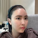 청담리즈피부과의원 | 청담피부과 솔린의원 관자필러 솔직 후기