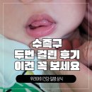 [수족구 A to Z] 수족구 증상부터 입원 기준, 등원 시기까지 완벽 정리 (ft. 두 번 걸린 생생 후기)