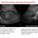 Renal cell carcinoma with tumour thrombus of IVC 이미지