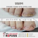 3761 | 부산 무좀 발톱 관리 잘하는 곳 레푸스 사상점-방치해서 불편했던 발톱 후기