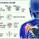 어께통증 8초만에 잡기 이미지