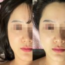 연산동에스테틱 뷰티블라썸 ㅣ 작은얼굴관리 후기