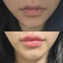 하나의원 | 입술필러 성지 리부팅의원 고윤정 입술 내돈내산 후기