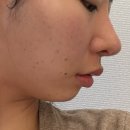 (주)우전브이티 | 서초동 피부과에서 튠라이너 &amp; 브이로어드밴스 받고 턱선 리프팅했어요