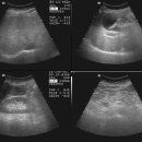 Abdomen 실제 초음파 이미지