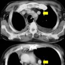 Left Superior Vena Cava 이미지