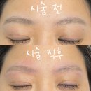 [부산 중구 중앙역] 모노브로우: 눈썹문신 제거(잔흔제거,유기색소)