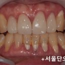 치과기공소 우주최강 네이버블로그