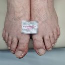 21C메트로한방병원 | “파주·일산 무좀치료는 치유본의원한의원! 손발 무좀·내성발톱 동시치료 성공 사례”