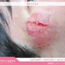 아무러스성형외과의원 | 대구얼굴상처 응급실보다 성형외과 치료가 필요한 이유는? (경과)