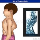 척추결핵[spinal tuberculosis] 이미지