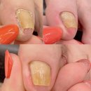 고미발톱 이미지