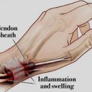 건막염[tenosynovitis] 이미지