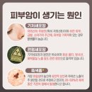 3대 피부암 중 하나 '기저세포암 이미지