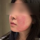 백피부과의원 | [지젤의원] 인모드 FX 내돈내산 후기 | 가격, 통증, 효과 솔직리뷰