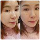 유투성형외과의원 | 림피드시술, 다크서클 눈밑꺼짐 노화방지 강남 유투성형외과 후기 대만족