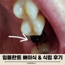 오스템임플란트(주) | 임플란트 뼈이식 및 식립 수술 통증 비용 주의사항 식사 후기