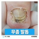 경기도 수원시 영통구 영통로 | 수원 영통) 20대 여성 무좀발톱, 젊다고 방치하면 안 되는 이유