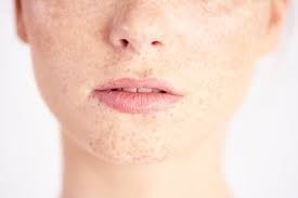 I am considering laser treatment for melasma. Which procedure should I get?